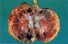 kidney disease